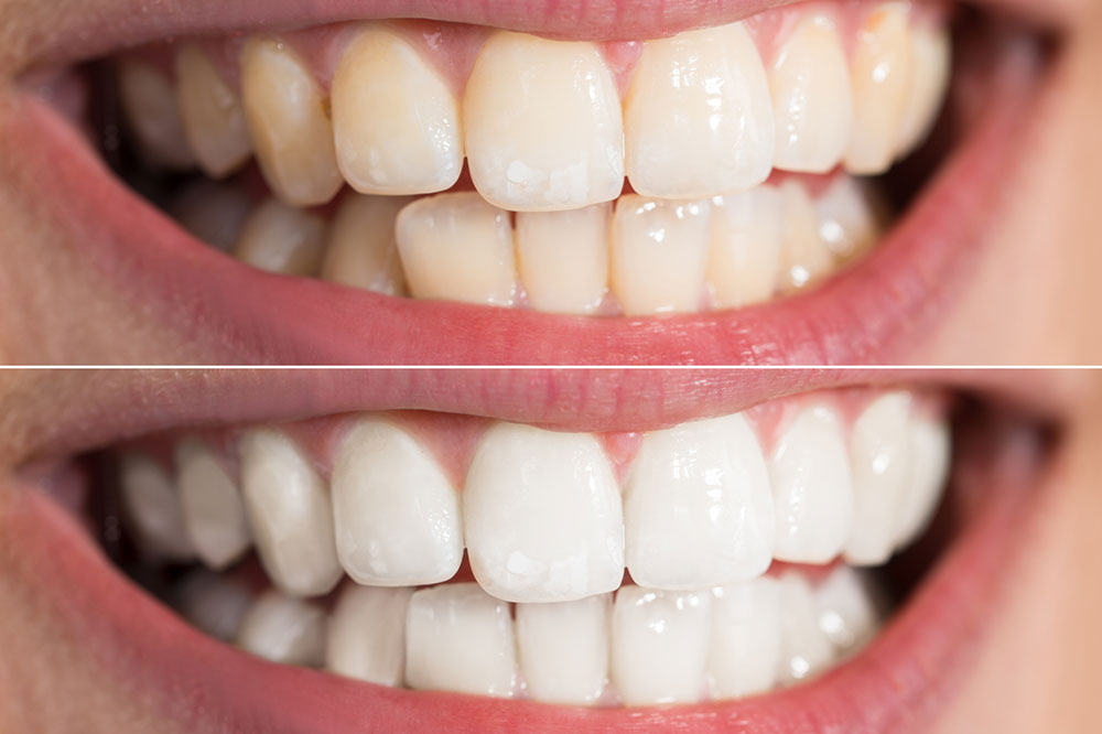 Natural and Inexpensive Ways to Whiten Teeth at Home